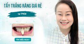 Tẩy trắng răng tại TPHCM giá rẻ