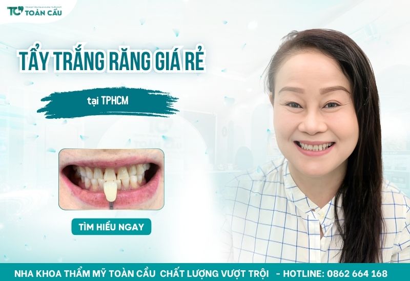 Tẩy trắng răng tại TPHCM giá rẻ