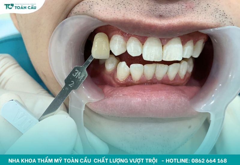 Tẩy trắng mang lại nụ cười tươi tắn và tự nhiên