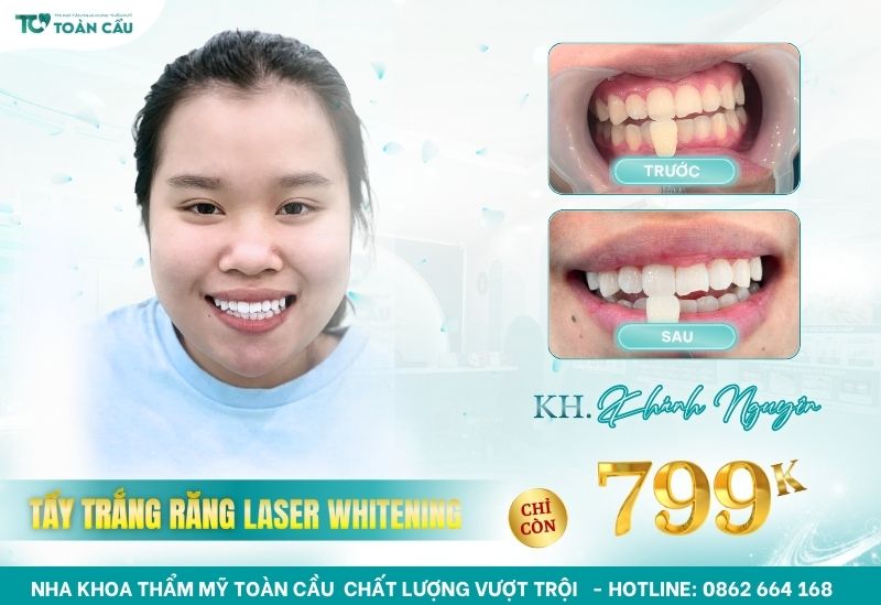 Khách hàng tẩy trắng răng tại TPHCM giá rẻ cùng Toàn Cầu