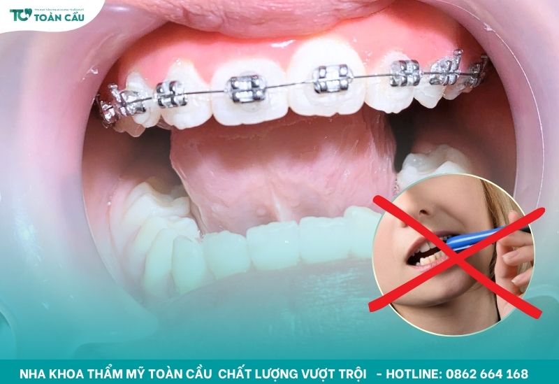 Những thói quen xấu cần tránh khi niềng răng để không làm lệch mắc cài 5 Cắn móng tay hoặc cắn bút là những thói quen xấu cần tránh