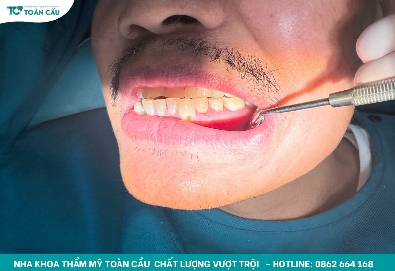 Địa chỉ trám răng hàm bị sâu tại Gò Vấp được đánh giá cao 5 Trám răng giúp khôi phục hình dáng và chức năng răng