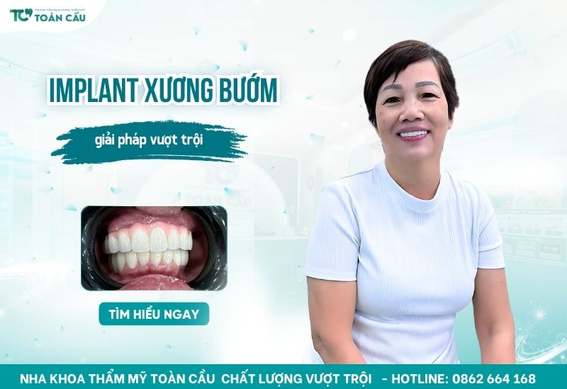 trồng implant xương bướm uy tín ở Gò Vấp