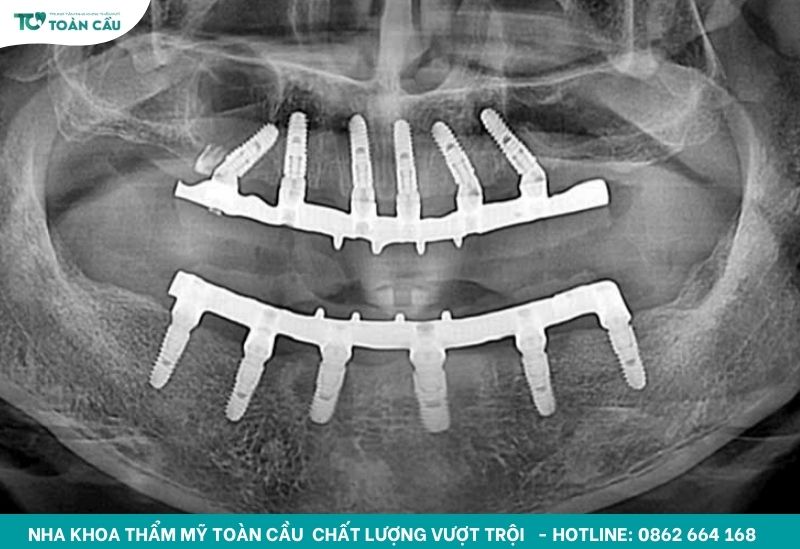 Trồng implant xương bướm uy tín ở Gò Vấp có đắt không? 5 Trồng implant xương bướm uy tín ở Gò Vấp có chi phí cao hơn