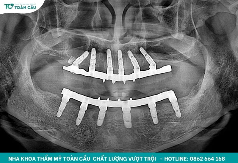 Trồng răng implant bao lâu thì lành? Giải đáp chi tiết 6 Quá trình tích hợp này thường kéo dài từ 6 đến 12 tuần
