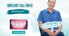 trồng răng implant toàn hàm All-on-6