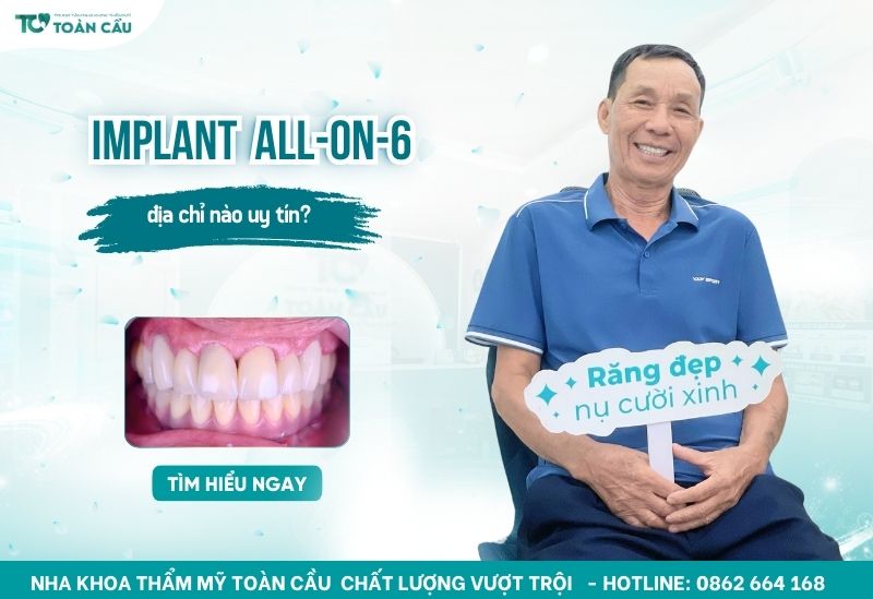 trồng răng implant toàn hàm All-on-6