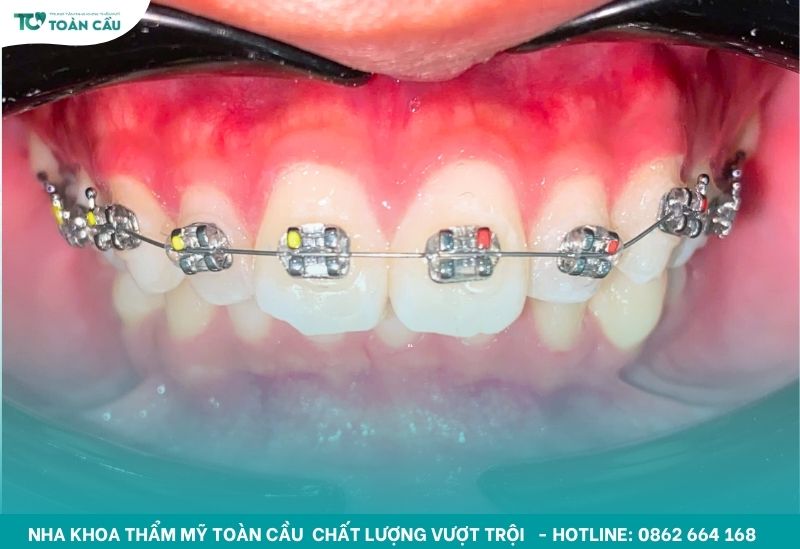 Vệ sinh răng miệng đúng cách khi niềng răng để tránh viêm nướu 5 Tìm hiểu cách vệ sinh răng miệng khi niềng là vô cùng quan trọng
