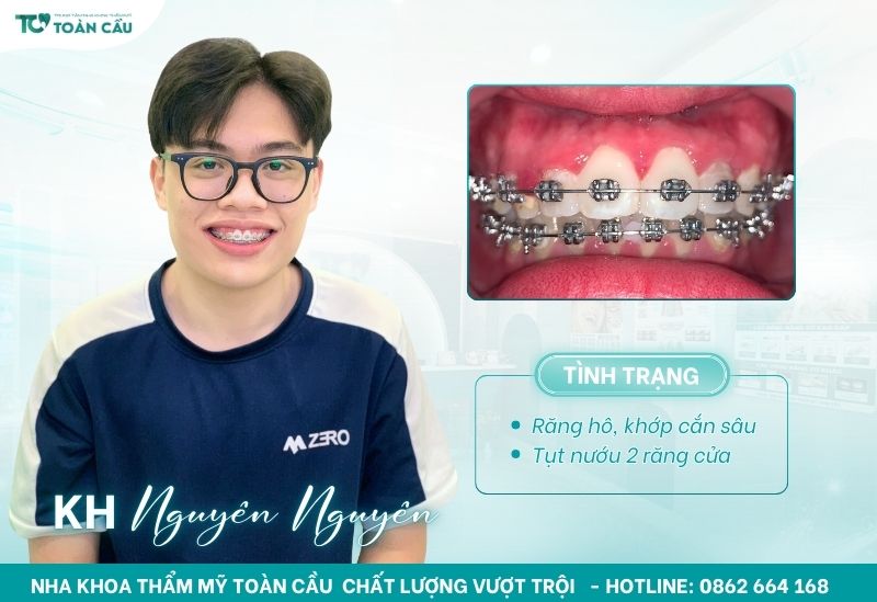 Vệ sinh răng miệng đúng cách khi niềng răng để tránh viêm nướu 8 Khách hàng niềng răng mắc cài kim loại tại Toàn Cầu