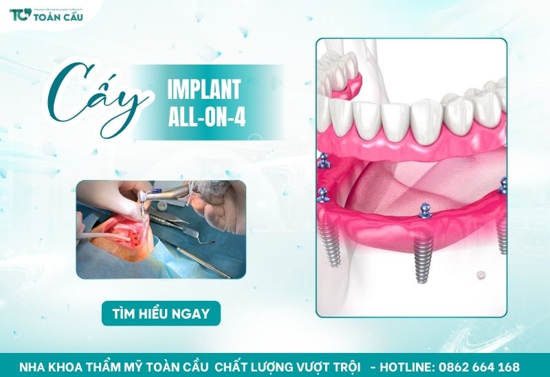 cấy ghép implant All on 4