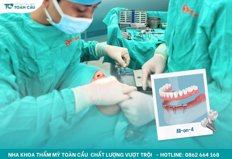 All-on-4 có nghĩa là bác sĩ sẽ đặt 4 trụ implant vào xương hàm