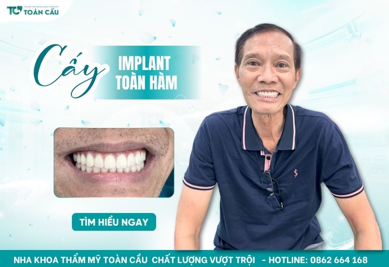 cấy ghép implant toàn hàm