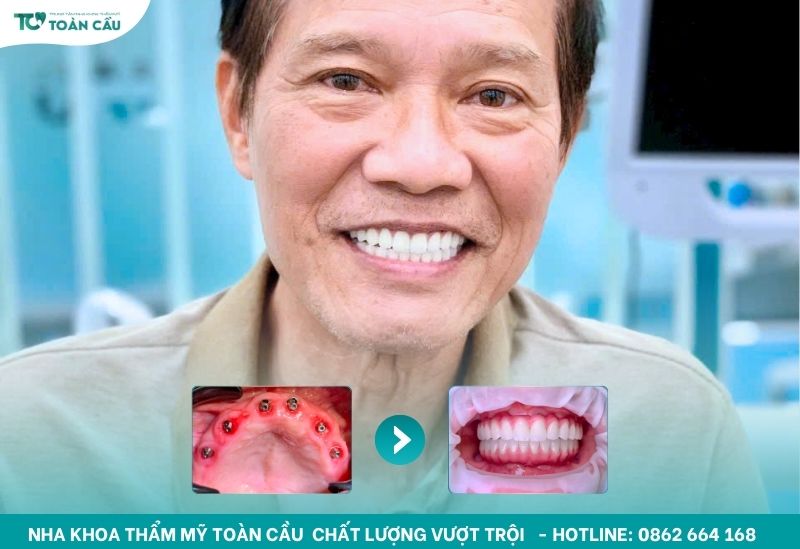Review thực tế của khách hàng từng trồng implant toàn hàm