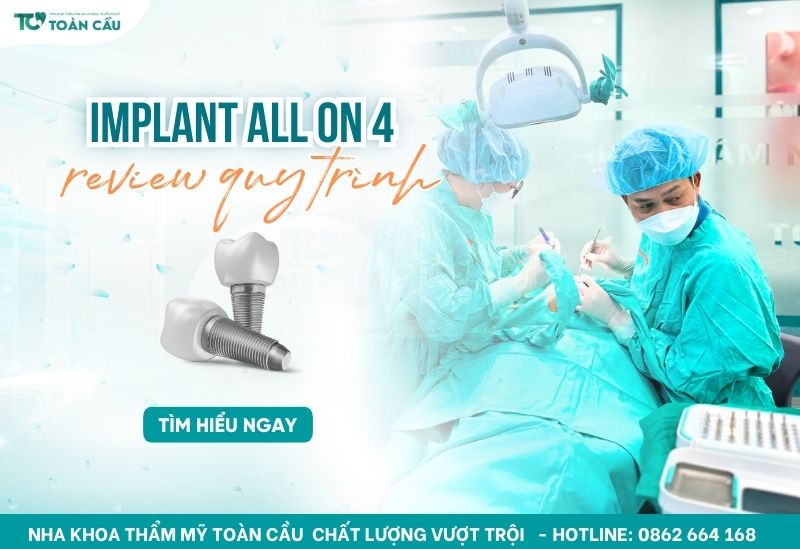 Cấy implant All on 4 không đau Gò Vấp