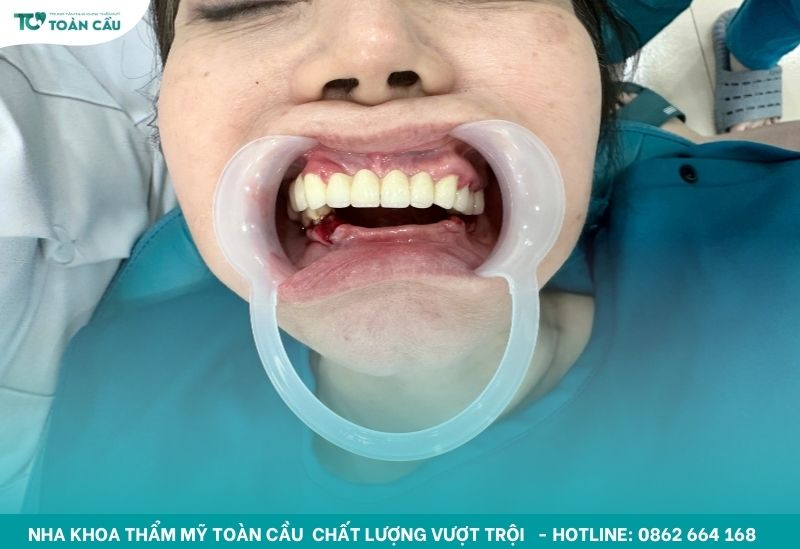 Cấy implant All-on-4 cho người mất răng toàn hàm