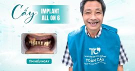 cấy implant All on 6 Gò Vấp bao lâu lành