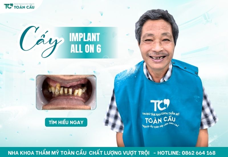 cấy implant All on 6 Gò Vấp bao lâu lành