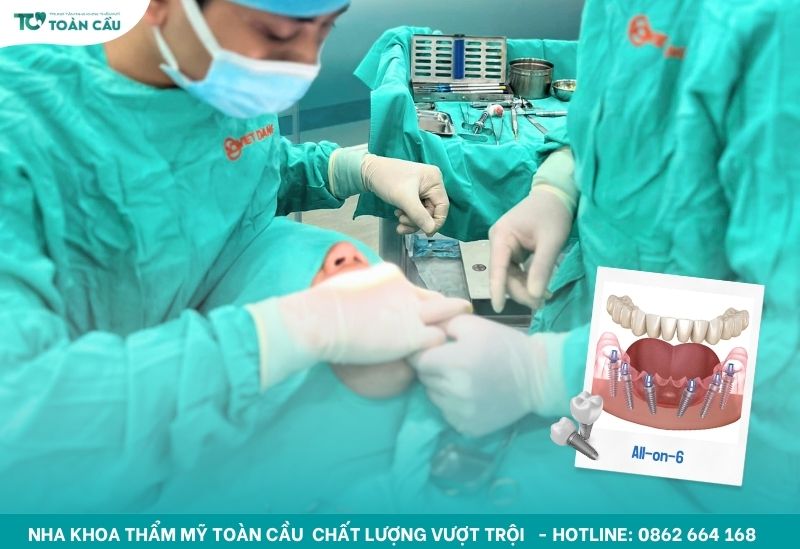Hiểu rõ cấy implant All on 6 Gò Vấp bao lâu lành