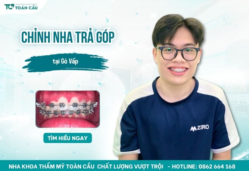 Chỉnh nha trả góp tại Gò Vấp