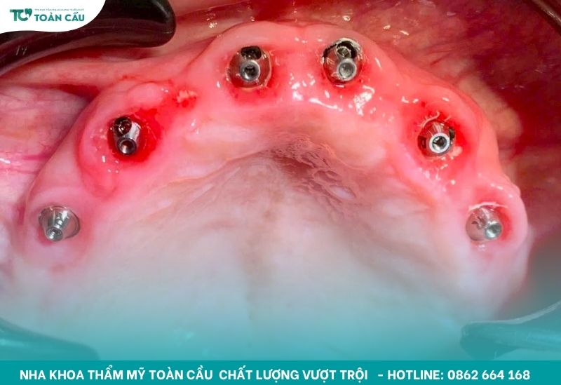 Răng Implant được gắn cố định trực tiếp vào xương hàm