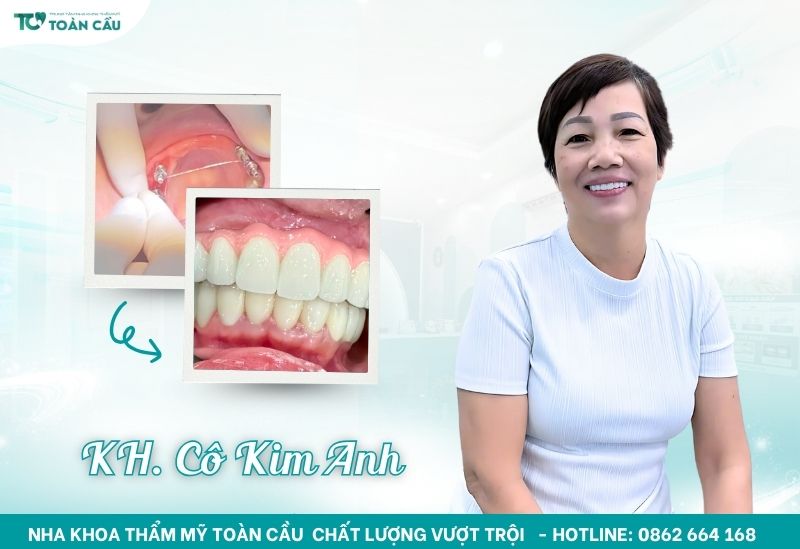 Cô Kim Anh vui vẻ chia sẻ về trải nghiệm cấy implant 