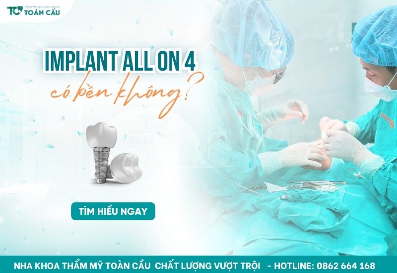 Implant All on 4 có bền không