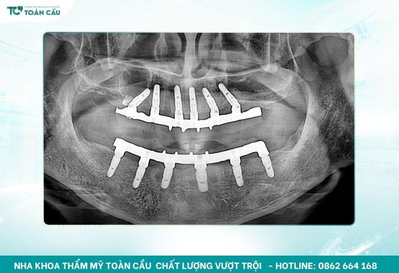 Trụ Implant là phần tiếp xúc trực tiếp với xương hàm