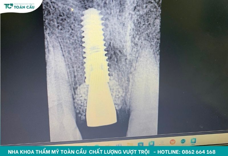 Mỗi trụ sẽ có một kiểu xoắn khác nhau