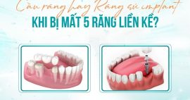 nên làm cầu răng hay răng sứ