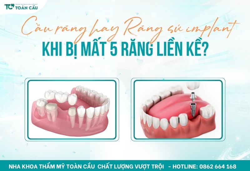 nên làm cầu răng hay răng sứ