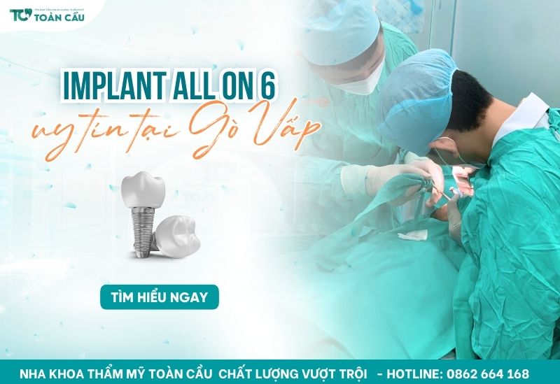 nha khoa cấy Implant All on 6 uy tín