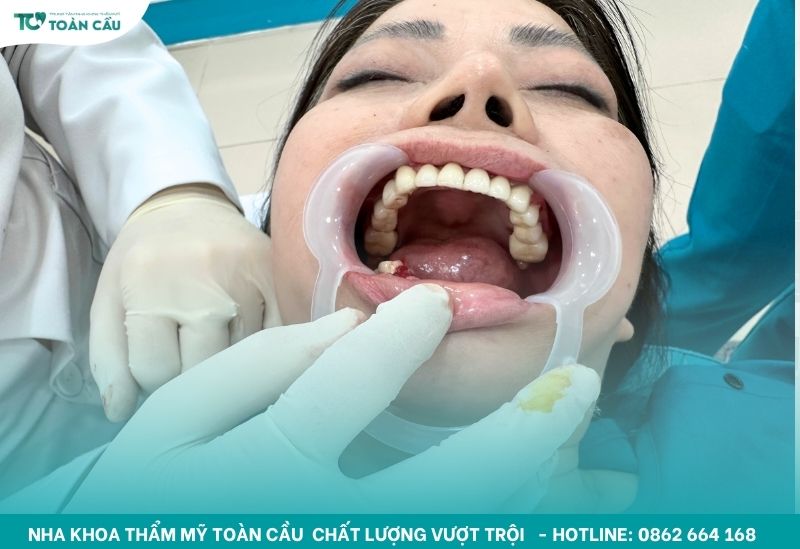 Implant All on 6 phục hình toàn hàm tiên tiến