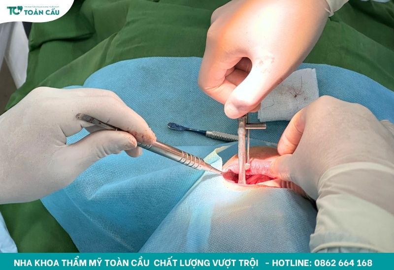 Cấy ghép All on 6 là một thủ thuật phức tạp