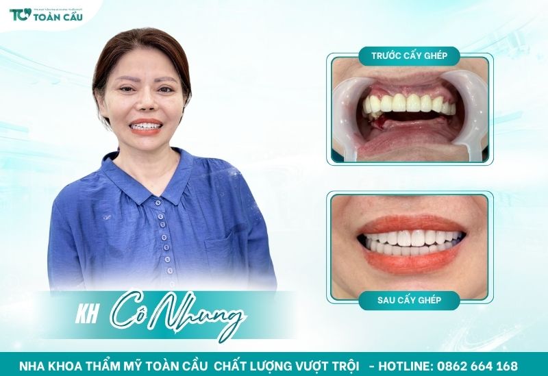 Trải nghiệm nha khoa implant an toàn Gò Vấp