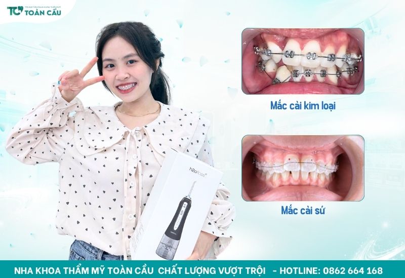 Niềng răng mắc cài kim loại là lựa chọn phổ biến