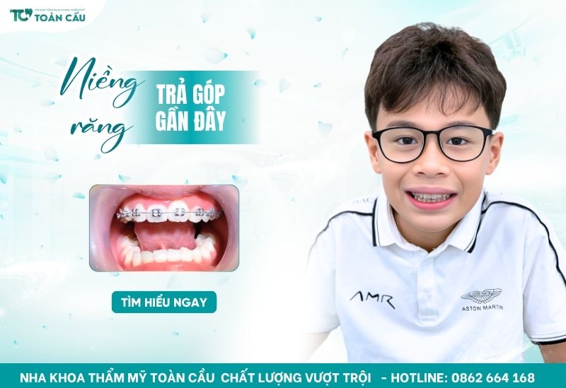 Niềng răng trả góp gần đây