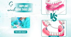 So sánh implant và hàm tháo lắp