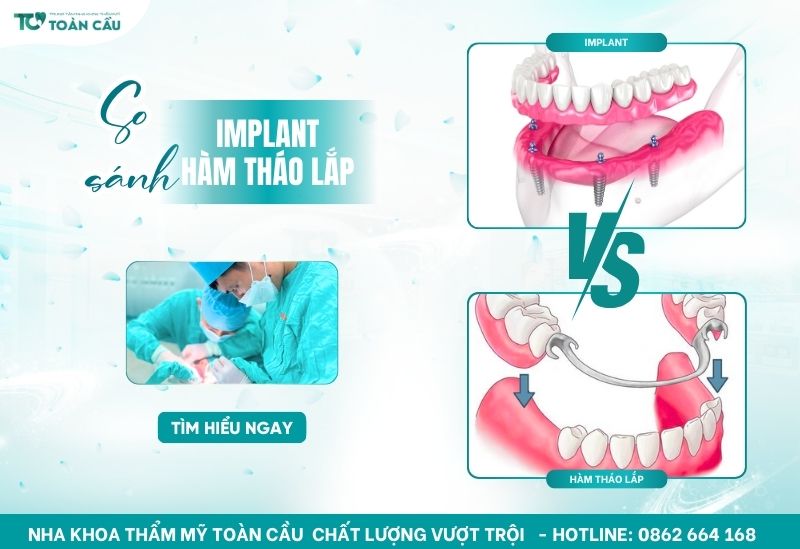 So sánh implant và hàm tháo lắp