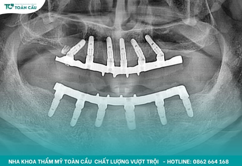 Cấy ghép implant toàn hàm All-on-6 tại Nha Khoa Thẩm Mỹ Toàn Cầu