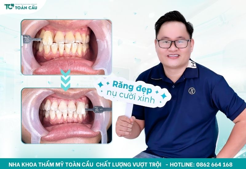 Khách hàng tẩy trắng răng tại Toàn Cầu
