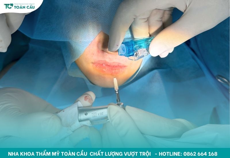 Trồng răng implant tại nha khoa uy tín
