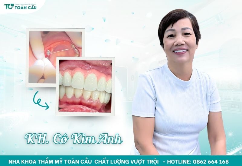 Cô Kim Anh trồng răng implant tại Toàn Cầu