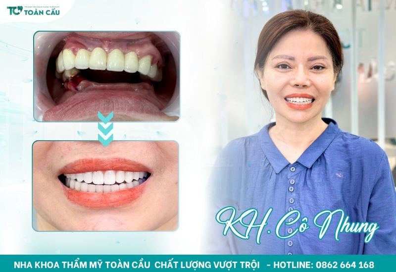 Khách hàng cấy ghép implant toàn hàm thành công