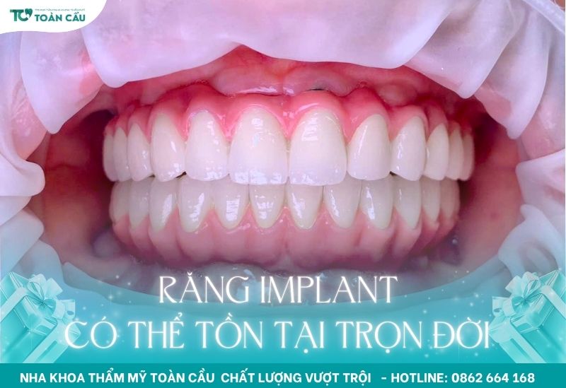 Răng Implant có thể tồn tại trọn đời
