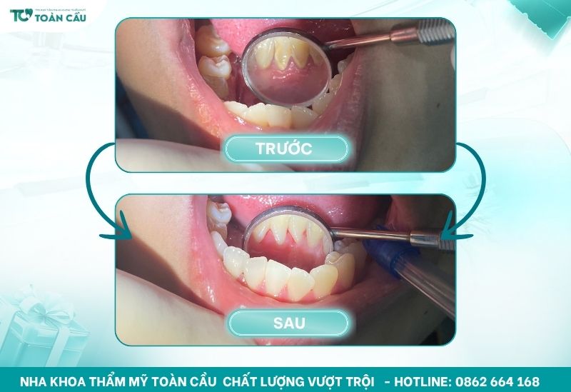 Cạo vôi răng có thể khiến răng sáng hơn