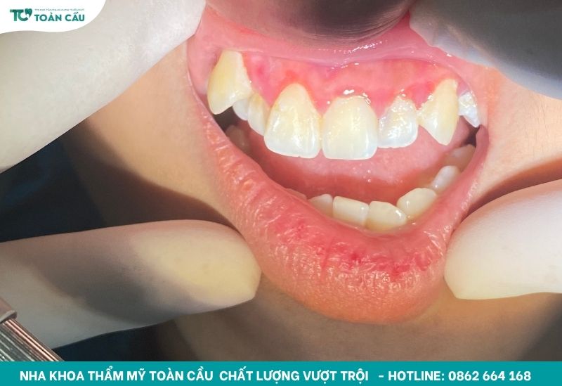 Có thể cạo vôi răng 6 tháng/ lần