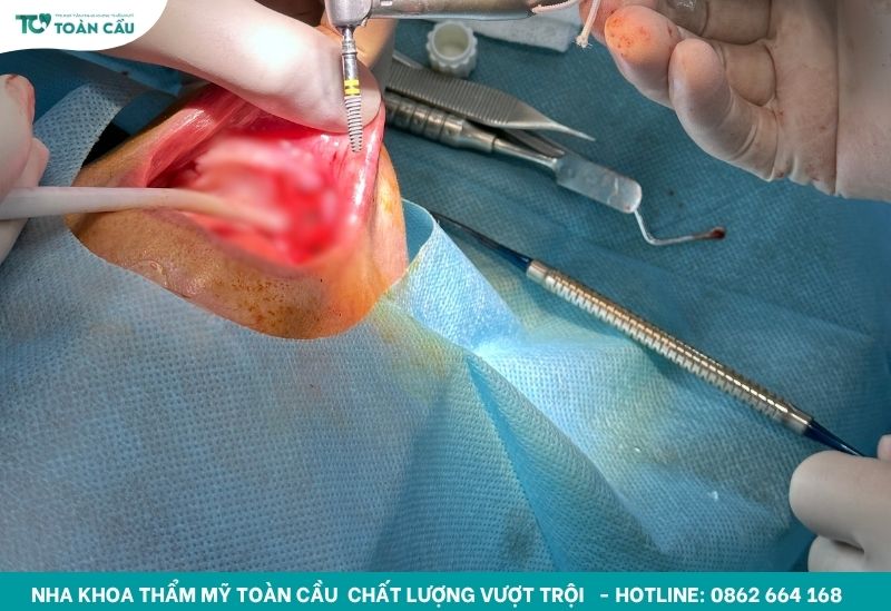 Top 7 nha khoa cấy ghép implant HCM uy tín và an toàn 9 Dịch vụ cấy ghép Implant HCM chất lượng