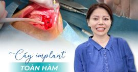 Cấy implant toàn hàm uy tín tại TPHCM