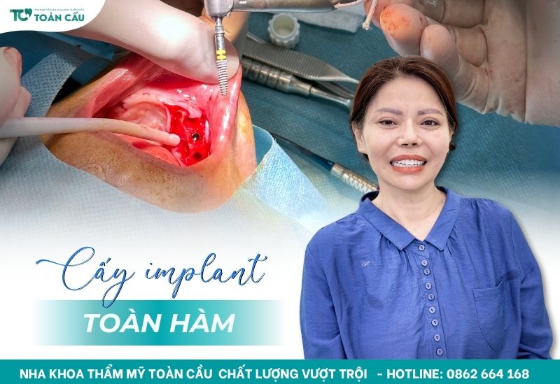 Cấy implant toàn hàm uy tín tại TPHCM