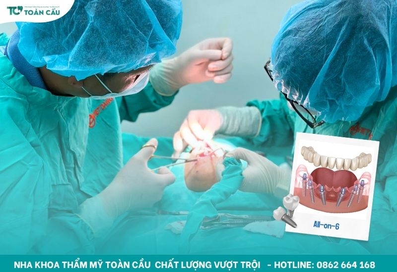 Nha khoa cấy implant toàn hàm uy tín tại TPHCM 6 Implant All-on-6
